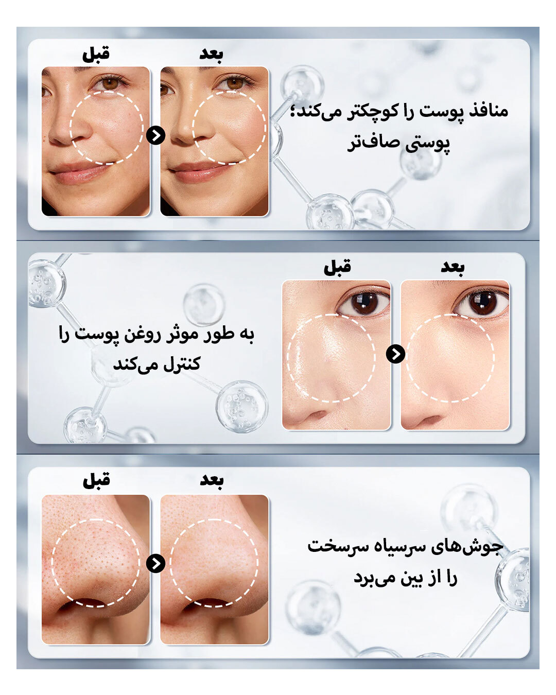  چسب بینی کاسه ای لانبنا BHA 2% 